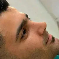 عمل بینی لیپوابدو لیفت غبغب دایرکت ابروتخفیف تهران|خدمات آرایشگری و زیبایی|قزوین, |دیوار