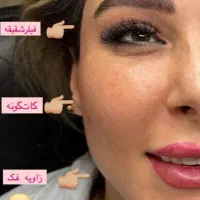 آف٪ ۵۰ درصدی تزریق فیلر و بوتاکس