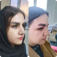 لیفت شقیقه وگونه با جراحی|خدمات آرایشگری و زیبایی|بوکان, |دیوار