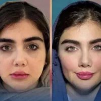 جشنواره تخفیف بوتاکس فیلر و مزو ژل و خال برداری