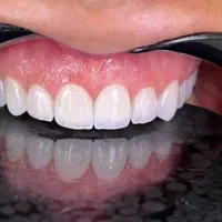 خدمات زیبایی کامپوزیت لمینیت بلیچینگ|خدمات آرایشگری و زیبایی|قم, زنبیل آباد|دیوار