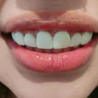 خدمات ویژه کامپوزیت ودندنسازی باقیمت ویژه|خدمات آرایشگری و زیبایی|یاسوج, |دیوار