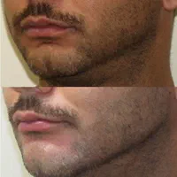 بوتاکس،لیزر،ژل،نخ گذاری و هایفودکتر شهبازی|خدمات آرایشگری و زیبایی|یزد, |دیوار