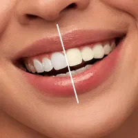 سفید کننده دندان|آرایشی، بهداشتی، درمانی|کرج, بنیاد|دیوار
