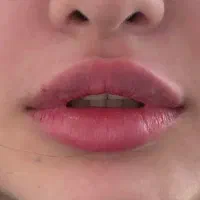 مدل تزریق فیلر لب  استایل نچرال