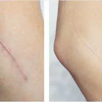 کاموفلاژ انواع جای زخم و بخیه/میکروبلیدینگ