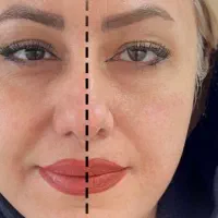 هایفوتراپی در مطب پزشک با قیمتی باورنکردنی|خدمات آرایشگری و زیبایی|مشهد, چهارچشمه|دیوار