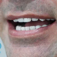 لمینیت لب شیشه قسطی کامپوزیت بلیچینگ دندان|خدمات آرایشگری و زیبایی|مشهد, سجاد شهر|دیوار