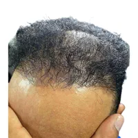 میکرواسکالپ|خدمات آرایشگری و زیبایی|تهران, قیطریه|دیوار