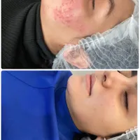پاکسازی صورت ، فیشال درمانی