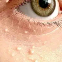 درمان کیست  ملیا زیر چشم و برداشتن خال و زگیل