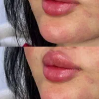 تزریق ژل بوتاکس فیلر لیزرجوانساز مزو مطب زیبایی|خدمات آرایشگری و زیبایی|تبریز, |دیوار