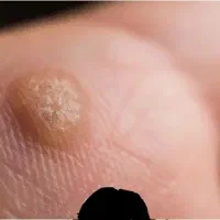 رفع ریشه ای و بدون بازگشت زگیل و تبخال تناسلی