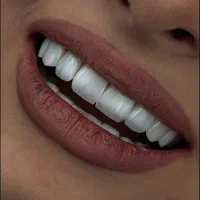 کامپوزیت دندان / دندانپزشکی / کامپوزیت / ایمپلنت