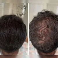میکرو اسکالپ سر|خدمات آرایشگری و زیبایی|شیراز, اصلاح‌نژاد|دیوار
