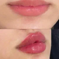 ژل لب، فیلر صورت، بوتاکس|خدمات آرایشگری و زیبایی|نجفآباد, امام خمینی|دیوار