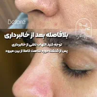 برداشت انواع خال صورت و بدن|خدمات آرایشگری و زیبایی|اهواز, کیانپارس |دیوار