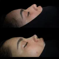 لیپو ۵۰ / ابدو ۵۹ / لیفت مامو ۵۰ /