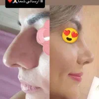 آفر ویژه عمل بینی /پلک /دندان/لیپوساکشن/غبغب|خدمات آرایشگری و زیبایی|شیراز, عفیف‌آباد|دیوار