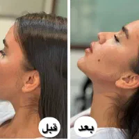 جشنواره ژل و بوتاکس و فیلر بادی و لیفت صورت|خدمات آرایشگری و زیبایی|تهران, صادقیه|دیوار