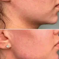 تزریق فیلر و بوتاکس و مزوتراپی توسط پزشک