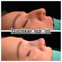 جشنواره عمل بینی فقط (۳۵) توسط متخصص|خدمات آرایشگری و زیبایی|شاهین‌شهر, فردوسی|دیوار