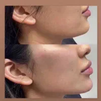 آموزش فیلربادی،فیلر،بوتاکس،مزوتراپی،مزو ژل