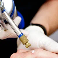 درمان زگیل پوستی/کرایو تراپی و لیزر/hpv