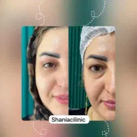 جراحی بلفاروپلاستی|خدمات آرایشگری و زیبایی|تهران, هفت حوض|دیوار