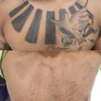 پاک کردن انواع تتو و بلفاروپلاستی در جنوب تهران