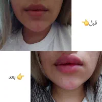 ژل و بوتاکس