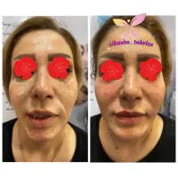 آموزش تزریق ژل بوتاکس مزو نخ ودیگر لاین های زیبایی|خدمات آموزشی|تبریز, |دیوار