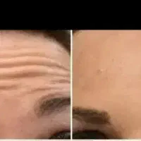 نیازمند مدل بوتاکس صورت،  گونه و زاویه فقط خانم