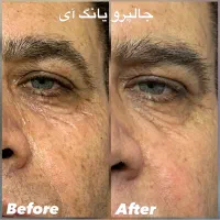 ژل لب روسی بوتاکس فیلر گونه چانه کانتورینگ