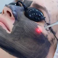کربن تراپی صورت با لیزر