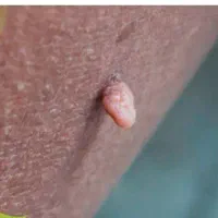 درمان تخصصی زگیل تناسلی توسط پزشک متخصص