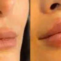 ژل و بوتاکس  تخفیف تابستانه  بوتاکس ۶۰۰