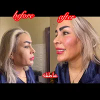 جشنواره فیلروبوتاکس مادلینگ‌صورت باتخفیف ویژه|خدمات آرایشگری و زیبایی|تهران, کوهک|دیوار