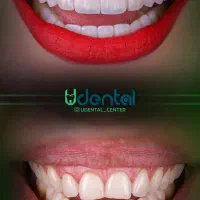 کامپوزیت، لمینت، ایمپلنت اقساط ویژه|خدمات آرایشگری و زیبایی|کازرون, |دیوار