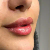 آموزش ژل و بوتاکس و....