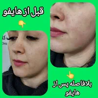 ** جوانسازی پوست با هایفو تنها ۹۸۰ هزار **|خدمات آرایشگری و زیبایی|تهران, نازی‌آباد|دیوار