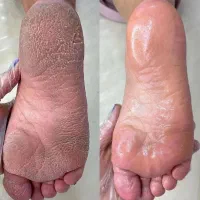 آف ویژه پدیکور حرفه ای فقط تا روز زن