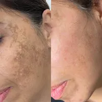 خدمات حرفه ای تخصصی،لک کک مک موی زائدسفیدالکترولیز|خدمات آرایشگری و زیبایی|قم, صفائیه|دیوار