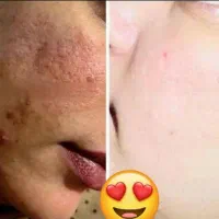 کرم سفید کننده صورت و بدن 10درجه سفیدی تضمینی