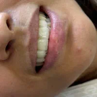 فرصت طلایی و محدود برای ایمپلنت دندان