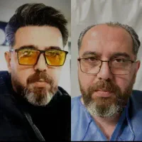 تخفیف کاشت مو،کاشت شیرازی فقط چند روز