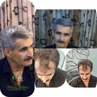 جشنواره کاشت مو و ابرو با تخفیف ویژه (ظرفیت محدود)