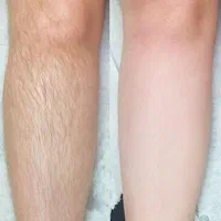 تخفیف لیزر موهای زائد