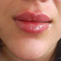 فیلر ، بوتاکس ، چال لپ ، پیرسینگ ،میکرونیدلینگ