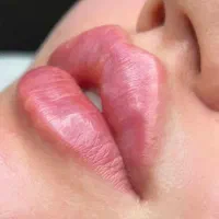 فیلر ده سیسی ماندلینگ صورت فقط ۶/۹۰۰ت